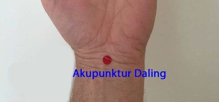CW - Akupunkturpunkt